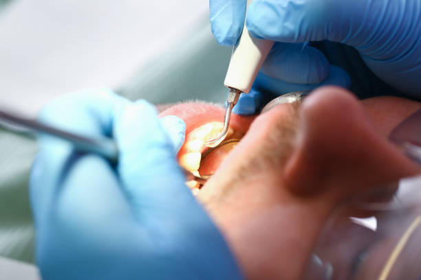 Best Emergency Dental Care for Broken or Chipped Teeth in Itasca, TX